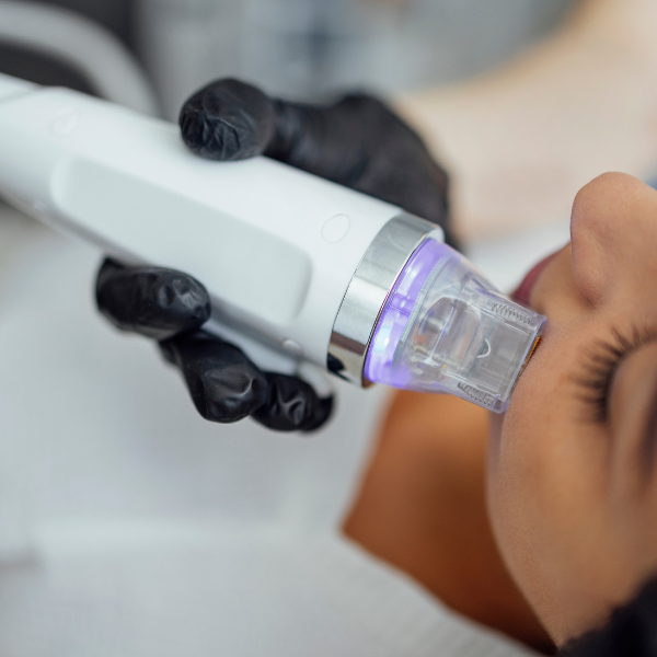 RF Microneedling